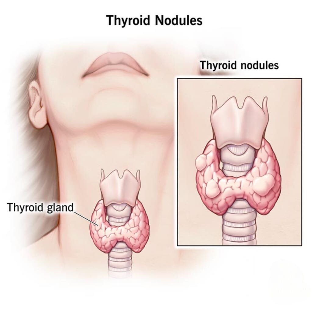 Thyroid Disorder